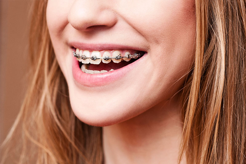 Orthodontics in Forth Worth, TX - Braces and Aligners in 76137